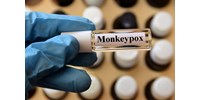  Tünetek nélkül is terjedhet a majomhimlő-vírus, több beteget is így diagnosztizáltak  