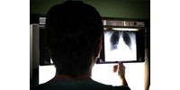  Egyetlen röntgenfelvételből megmondja a mesterséges intelligencia, 10 éven belül lesz-e szívrohamunk  