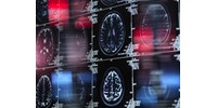  Ráengedik a mesterséges intelligenciát 1,6 millió agyfelvételre, áttörés jöhet a demencia kezelésében  