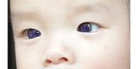  Barnáról hirtelen kékre változott a szeme annak a fiúnak, aki egy közismert koronavírus elleni gyógyszert kapott  