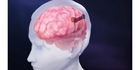  4096 elektródát ültettek egy emberi agyba, jelentős eredményt ért el a Neuralink riválisa  