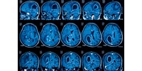  Betolták az fMRI-gépbe az önkénteseket, a mesterséges intelligencia kiolvasta, mire gondolnak  