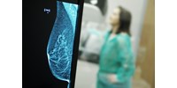  A mellrák kezelésében is áttörést hozhat a mesterséges intelligencia  