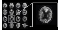  Betiltották a kezelést, miután kiderült: agyról agyra is átterjedhet az Alzheimer-kór  