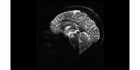  Bekapcsolták a világ legerősebb MRI-gépét, lenyűgöző, milyen képet készít az agyról  