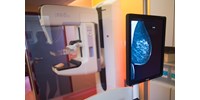 Mégsem lesznek kötelezők a rákszűrések januártól
