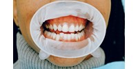  A fogukat nem naponta 3-szor, vagy nem alaposan mosóknak dob mentőövet egy új magyar módszer  